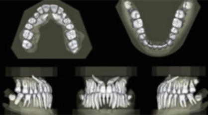 奈良・宇陀市の松田歯科医院の歯科用CTでは見えない物が見える様になります